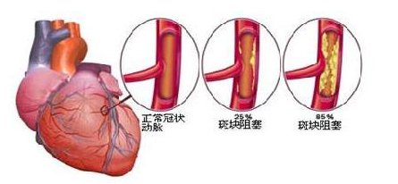 國(guó)康全自動(dòng)生化分析儀分析冠心病的發(fā)病原理