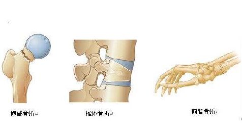 便攜式骨密度檢測(cè)儀廠家提醒如何預(yù)防骨質(zhì)疏松